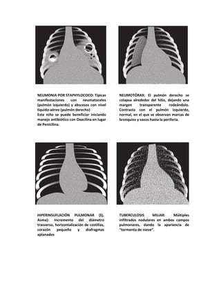 NEUMONIA POR STAPHYLOCOCO: Típicas
manifestaciones con neumatoceles
(pulmón izquierdo) y abscesos con nivel
líquido-aéreo (pulmón derecho)
Este niño se puede beneficiar iniciando
manejo antibiótico con Oxacilina en lugar
de Penicilina.
NEUMOTÓRAX: El pulmón derecho se
colapsa alrededor del hilio, dejando una
margen transparente rodeándolo.
Contrasta con el pulmón izquierdo,
normal, en el que se observan marcas de
bronquios y vasos hasta la periferia.
HIPERINSUFLACIÓN PULMONAR (Ej.
Asma): Incremento del diámetro
trasverso, horizontalización de costillas,
corazón pequeño y diafragmas
aplanados
TUBERCULOSIS MILIAR: Múltiples
infiltrados nodulares en ambos campos
pulmonares, dando la apariencia de
“tormenta de nieve”.
 