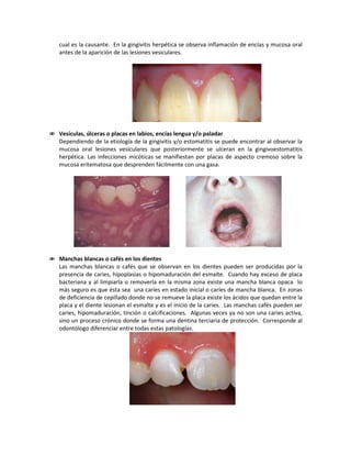 cual es la causante. En la gingivitis herpética se observa inflamación de encías y mucosa oral
antes de la aparición de las lesiones vesiculares.
 Vesículas, úlceras o placas en labios, encías lengua y/o paladar
Dependiendo de la etiología de la gingivitis y/o estomatitis se puede encontrar al observar la
mucosa oral lesiones vesiculares que posteriormente se ulceran en la gingivoestomatitis
herpética. Las infecciones micóticas se manifiestan por placas de aspecto cremoso sobre la
mucosa eritematosa que desprenden fácilmente con una gasa.
 Manchas blancas o cafés en los dientes
Las manchas blancas o cafés que se observan en los dientes pueden ser producidas por la
presencia de caries, hipoplasias o hipomaduración del esmalte. Cuando hay exceso de placa
bacteriana y al limpiarla o removerla en la misma zona existe una mancha blanca opaca lo
más seguro es que ésta sea una caríes en estado inicial o caríes de mancha blanca. En zonas
de deficiencia de cepillado donde no se remueve la placa existe los ácidos que quedan entre la
placa y el diente lesionan el esmalte y es el inicio de la caries. Las manchas cafés pueden ser
caries, hipomaduración, tinción o calcificaciones. Algunas veces ya no son una caries activa,
sino un proceso crónico donde se forma una dentina terciaria de protección. Corresponde al
odontólogo diferenciar entre todas estas patologías.
 