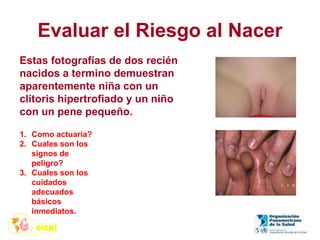 Evaluar el Riesgo al Nacer
1. Como actuaría?
2. Cuales son los
signos de
peligro?
3. Cuales son los
cuidados
adecuados
básicos
inmediatos.
Estas fotografías de dos recién
nacidos a termino demuestran
aparentemente niña con un
clítoris hipertrofiado y un niño
con un pene pequeño.
 