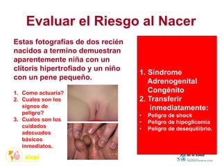 Evaluar el Riesgo al Nacer
1. Como actuaría?
2. Cuales son los
signos de
peligro?
3. Cuales son los
cuidados
adecuados
básicos
inmediatos.
Estas fotografías de dos recién
nacidos a termino demuestran
aparentemente niña con un
clítoris hipertrofiado y un niño
con un pene pequeño.
1. Síndrome
Adrenogenital
Congénito
2. Transferir
inmediatamente:
• Peligro de shock
• Peligro de hipoglicemia
• Peligro de desequilibrio.
 