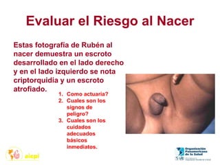 Evaluar el Riesgo al Nacer
1. Como actuaría?
2. Cuales son los
signos de
peligro?
3. Cuales son los
cuidados
adecuados
básicos
inmediatos.
Estas fotografía de Rubén al
nacer demuestra un escroto
desarrollado en el lado derecho
y en el lado izquierdo se nota
criptorquidia y un escroto
atrofiado.
 