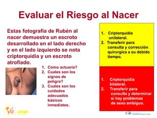 Evaluar el Riesgo al Nacer
1. Como actuaría?
2. Cuales son los
signos de
peligro?
3. Cuales son los
cuidados
adecuados
básicos
inmediatos.
Estas fotografía de Rubén al
nacer demuestra un escroto
desarrollado en el lado derecho
y en el lado izquierdo se nota
criptorquidia y un escroto
atrofiado.
1. Criptorquidia
unilateral.
2. Transferir para
consulta y corrección
quirurgica a su debido
tiempo.
1. Criptorquidia
bilateral.
2. Transferir para
consulta y determinar
si hay problemas
de sexo ambiguo.
 