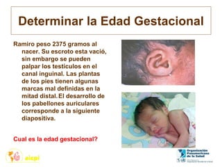 Determinar la Edad Gestacional
Ramiro peso 2375 gramos al
nacer. Su escroto esta vació,
sin embargo se pueden
palpar los testículos en el
canal inguinal. Las plantas
de los pies tienen algunas
marcas mal definidas en la
mitad distal.El desarrollo de
los pabellones auriculares
corresponde a la siguiente
diapositiva.
Cual es la edad gestacional?
 
