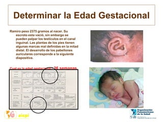 Determinar la Edad Gestacional
Ramiro peso 2375 gramos al nacer. Su
escroto esta vació, sin embargo se
pueden palpar los testículos en el canal
inguinal. Las plantas de los pies tienen
algunas marcas mal definidas en la mitad
distal. El desarrollo de los pabellones
auriculares corresponde a la siguiente
diapositiva.
Cual es la edad gestacional? 36 semanas.
 