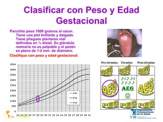 Clasificar con Peso y Edad
Gestacional
Panchito peso 1000 gramos al nacer.
Tiene una piel brillante y delgada.
Tiene pliegues plantares mal
definidos en ½ distal. Su glándula
mamaria no es palpable y el pezón
es plano de 1-2 mm. de diámetro.
Clasifique con peso y edad gestacional.
♪♫♪♪♫
♪♪♪♪
AEG
☺
Pre-término Término Post-término
 