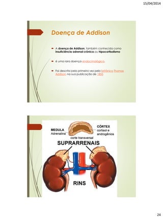 15/04/2014
24
Doença de Addison
 A doença de Addison, também conhecida como
insuficiência adrenal crônica ou hipocortisolismo
 é uma rara doença endocrinológica.
 Foi descrita pela primeira vez pelo britânico Thomas
Addison na sua publicação de 1855
 