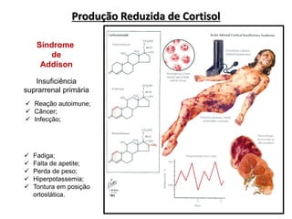 Produção Reduzida de Cortisol
Rang et al., 2003. Farmacologia, 5a ed.
Síndrome
de
Addison
Insuficiência
suprarrenal primária
 Reação autoimune;
 Câncer;
 Infecção;
 Fadiga;
 Falta de apetite;
 Perda de peso;
 Hiperpotassemia;
 Tontura em posição
ortostática.
 