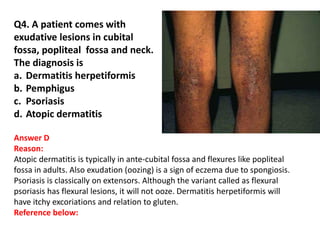 Q4. A patient comes with
exudative lesions in cubital
fossa, popliteal fossa and neck.
The diagnosis is
a. Dermatitis herpetiformis
b. Pemphigus
c. Psoriasis
d. Atopic dermatitis
Answer D
Reason:
Atopic dermatitis is typically in ante-cubital fossa and flexures like popliteal
fossa in adults. Also exudation (oozing) is a sign of eczema due to spongiosis.
Psoriasis is classically on extensors. Although the variant called as flexural
psoriasis has flexural lesions, it will not ooze. Dermatitis herpetiformis will
have itchy excoriations and relation to gluten.
Reference below:
 