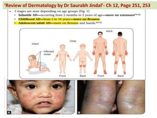 Re ie of Dermatology by Dr Saurabh Jindal - Ch 12, Page 251, 253
 