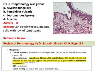 Q9 . Histopathology was given:
a. Mycosis fungoides
b. Pemphigus vulgaris
c. Lepromatous leprosy
d. Eczema
Answer – B
Reason: Can clearly see a suprabasal
split with row of tombstones
Reference below:
Re ie of Dermatology by Dr Saurabh Jindal - Ch 9, Page 181
 