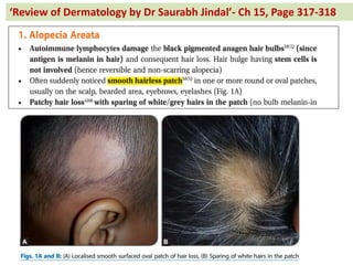 Re ie of Dermatology by Dr Saurabh Jindal - Ch 15, Page 317-318
 