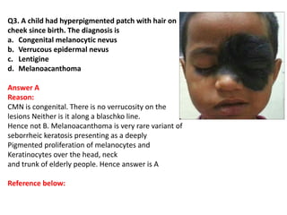 Q3. A child had hyperpigmented patch with hair on
cheek since birth. The diagnosis is
a. Congenital melanocytic nevus
b. Verrucous epidermal nevus
c. Lentigine
d. Melanoacanthoma
Answer A
Reason:
CMN is congenital. There is no verrucosity on the
lesions Neither is it along a blaschko line.
Hence not B. Melanoacanthoma is very rare variant of
seborrheic keratosis presenting as a deeply
Pigmented proliferation of melanocytes and
Keratinocytes over the head, neck
and trunk of elderly people. Hence answer is A
Reference below:
 