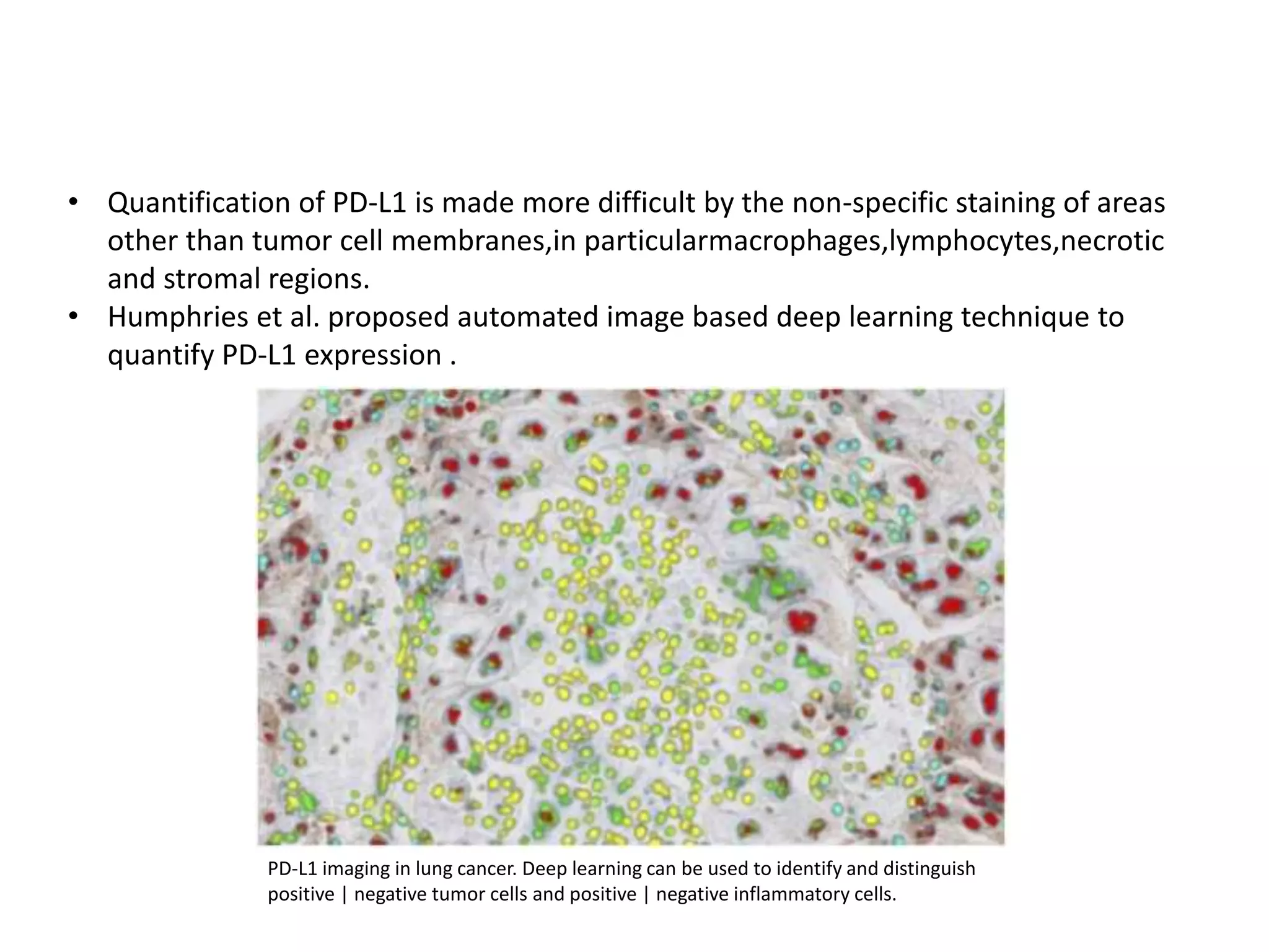 • Quantification of PD-L1 is made more difficult by the non-specific staining of areas
other than tumor cell membranes,in particularmacrophages,lymphocytes,necrotic
and stromal regions.
• Humphries et al. proposed automated image based deep learning technique to
quantify PD-L1 expression .
PD-L1 imaging in lung cancer. Deep learning can be used to identify and distinguish
positive | negative tumor cells and positive | negative inflammatory cells.
 