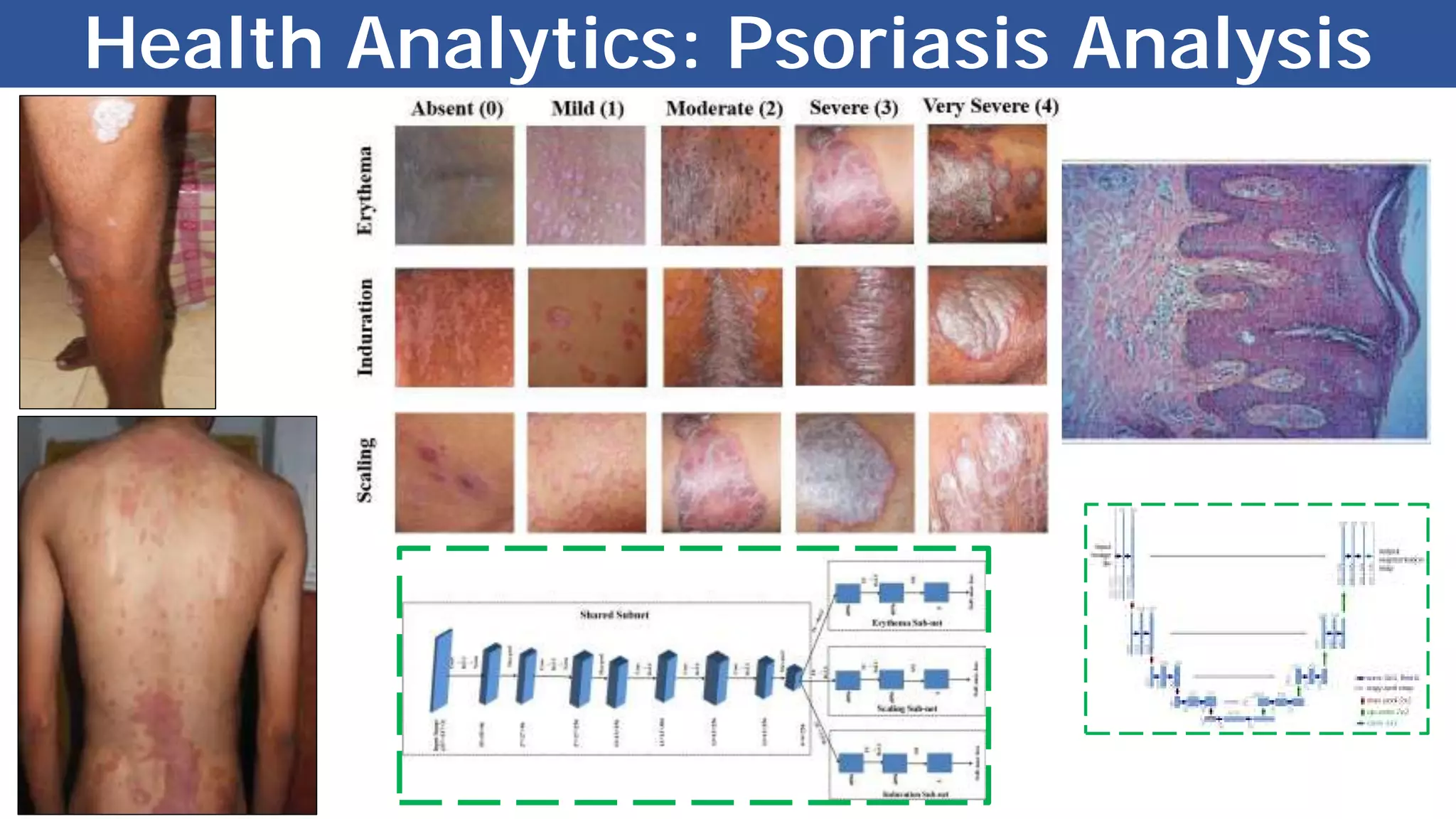 Health Analytics: Psoriasis Analysis
 