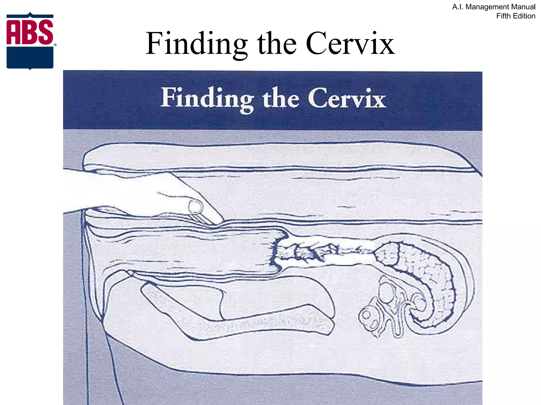 Finding the Cervix 