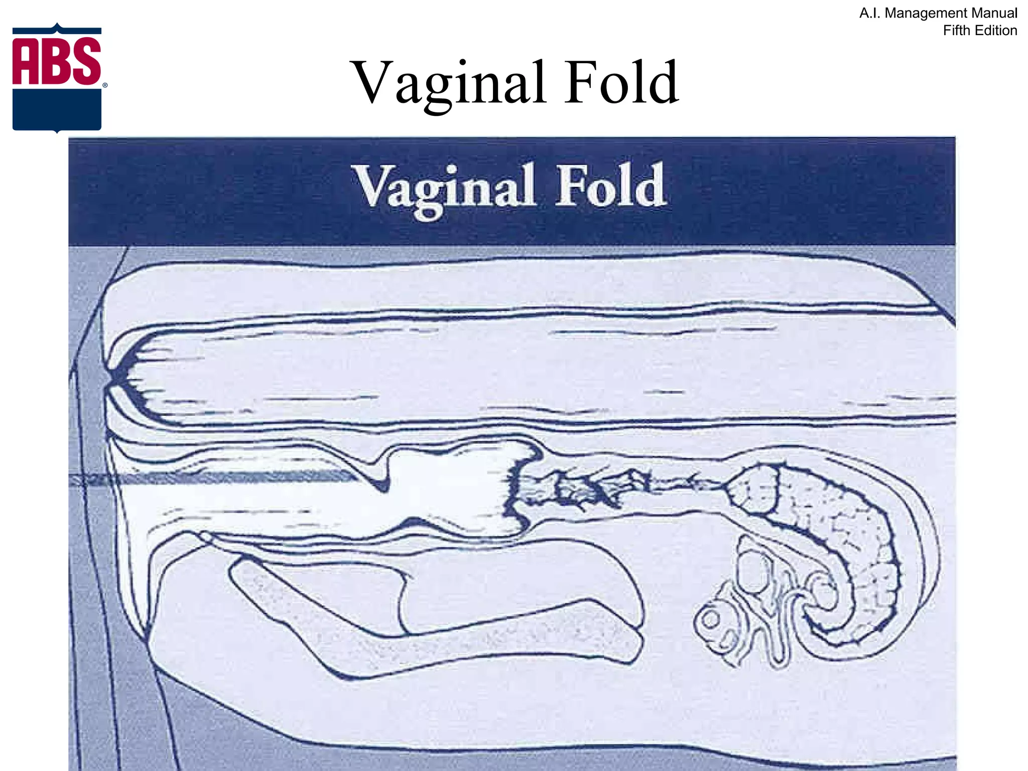 Vaginal Fold 