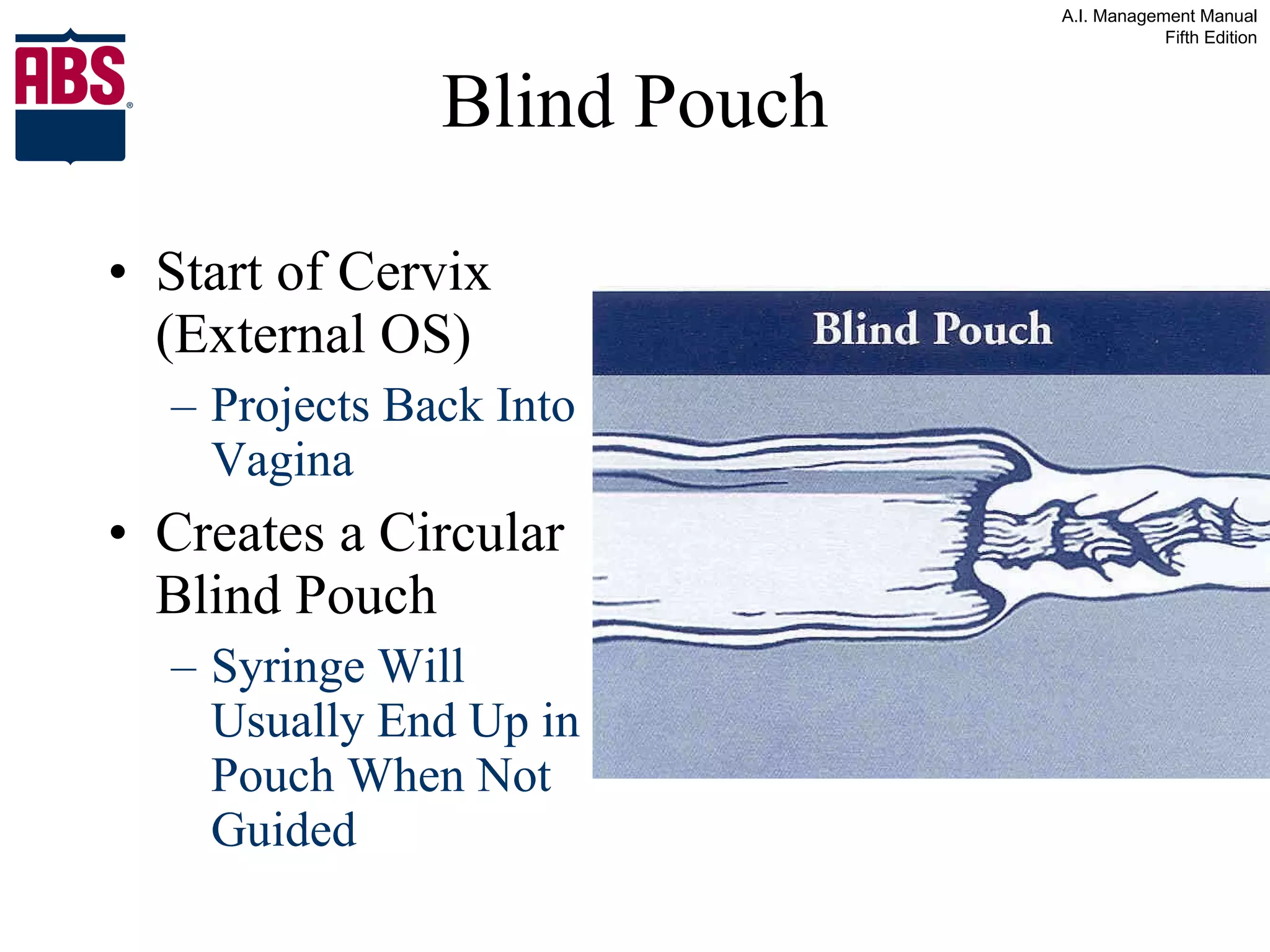 Blind Pouch Start of Cervix (External OS)  Projects Back Into Vagina Creates a Circular Blind Pouch Syringe Will Usually End Up in Pouch When Not Guided 