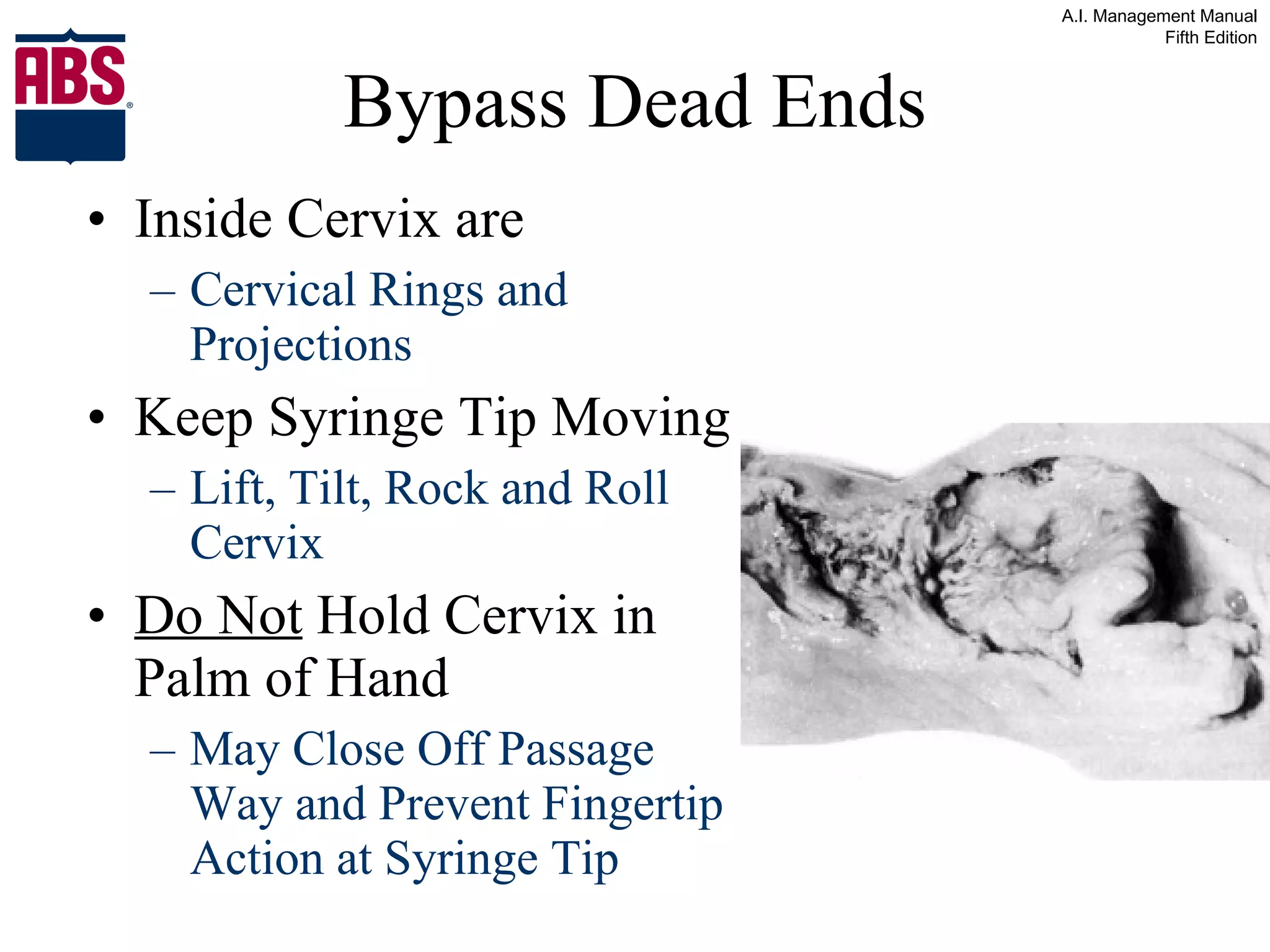 Bypass Dead Ends Inside Cervix are  Cervical Rings and Projections Keep Syringe Tip Moving  Lift, Tilt, Rock and Roll Cervix Do Not  Hold Cervix in Palm of Hand May Close Off Passage Way and Prevent Fingertip Action at Syringe Tip 