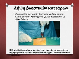 Λήψη βλαστικών κυττάρων
Η λήψη μυελού των οστών έως τώρα γινόταν από τα
πλατιά οστά της λεκάνης υπό γενική αναισθησία, με
ειδική βελόνα.
Πλέον,η διαδιακασία αυτή ανήκει στην ιστορία της ιατρικής και
σήμερα μόνο το 2% των περιπτώσεων λήψης μυελού των οστών
γίνεται έτσι.
 