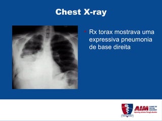 Chest X-ray Rx torax mostrava uma expressiva pneumonia de base direita 