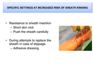 SPECIFIC SETTINGS AT INCREASED RISK OF SHEATH KINKING
SPECIFIC SETTINGS AT INCREASED RISK OF SHEATH KINKING

• Resistance to sheath insertion
– Short skin nick
– Push the sheath carefully
• During attempts to replace the
sheath in case of slippage.
– Adhesive dressing

 