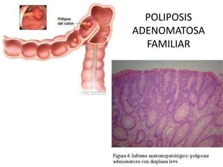 POLIPOSIS
ADENOMATOSA
FAMILIAR
 