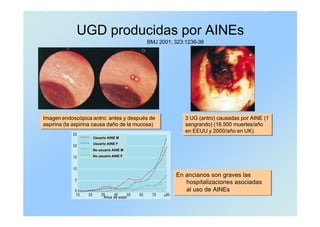 UGD producidas por AINEs
En ancianos son graves las
hospitalizaciones asociadas
al uso de AINEs
En ancianos son graves las
hospitalizaciones asociadas
al uso de AINEs
3 UG (antro) causadas por AINE (1
sangrando) (16.500 muertes/año
en EEUU y 2000/año en UK)
3 UG (antro) causadas por AINE (1
sangrando) (16.500 muertes/año
en EEUU y 2000/año en UK)
BMJ 2001; 323:1236-39
Imagen endoscópica antro: antes y después de
aspirina (la aspirina causa daño de la mucosa)
Imagen endoscópica antro: antes y después de
aspirina (la aspirina causa daño de la mucosa)
Usuario AINE M
Usuario AINE F
No usuario AINE M
No usuario AINE F
Años de edad
 