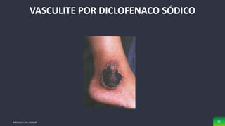VASCULITE POR DICLOFENACO SÓDICO
Adicionar um rodapé 52
 