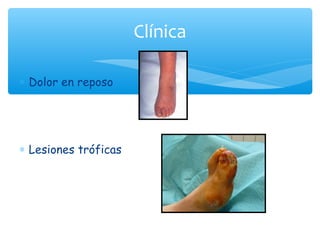 Clínica

∗ Dolor en reposo




∗ Lesiones tróficas
 