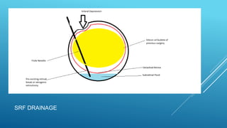 INTERFACE VITRECTOMY UNDER SILICONE OIL -AJAY DUDANI | PPTX