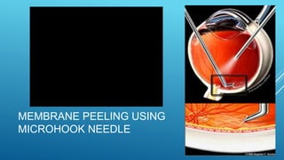 INTERFACE VITRECTOMY UNDER SILICONE OIL -AJAY DUDANI | PPTX