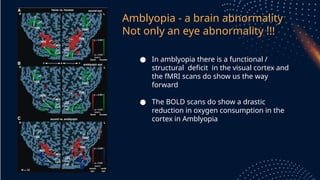Amblyopia and Orthoptek as presented in AIOC 2022.pptx
