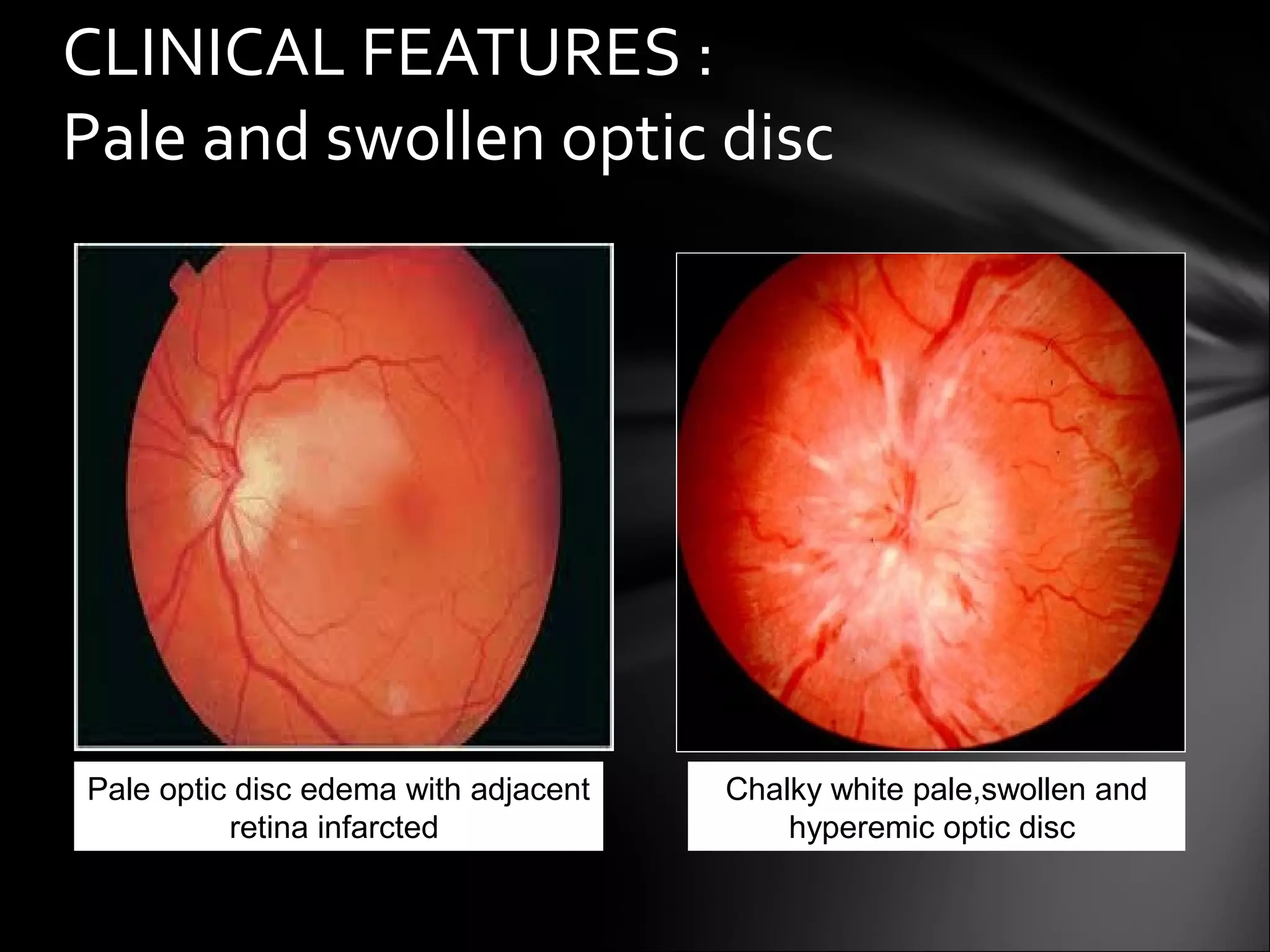 AION Anterior Ischemic Optic Neuropathy | PPT