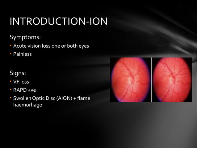 AION Anterior Ischemic Optic Neuropathy | PPT
