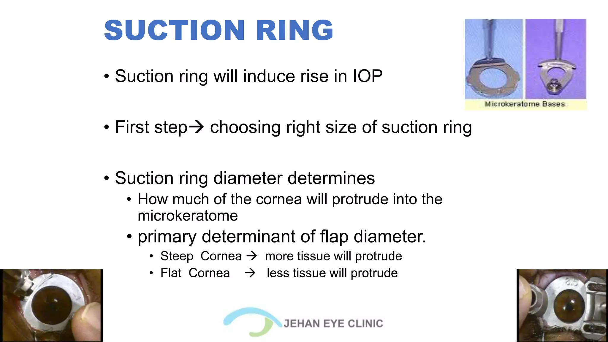 Current overview of Microkeratomes | PPTX
