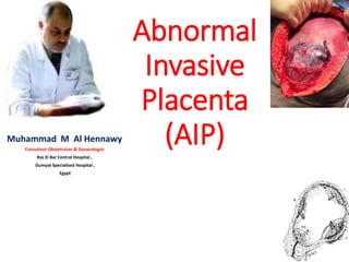 Abnormal
Invasive
Placenta
(AIP)Muhammad M Al Hennawy
Consultant Obstetrician & Gynacologist
Ras El Bar Central Hospital ,
Dumyat Specialised Hospital ,
Egypt
 