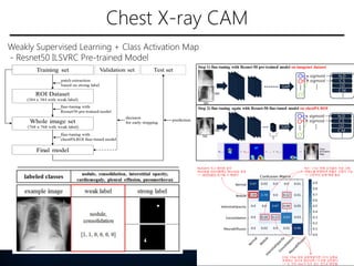 Chest X-ray CAM
Weakly Supervised Learning + Class Activation Map
- Resnet50 ILSVRC Pre-trained Model
 