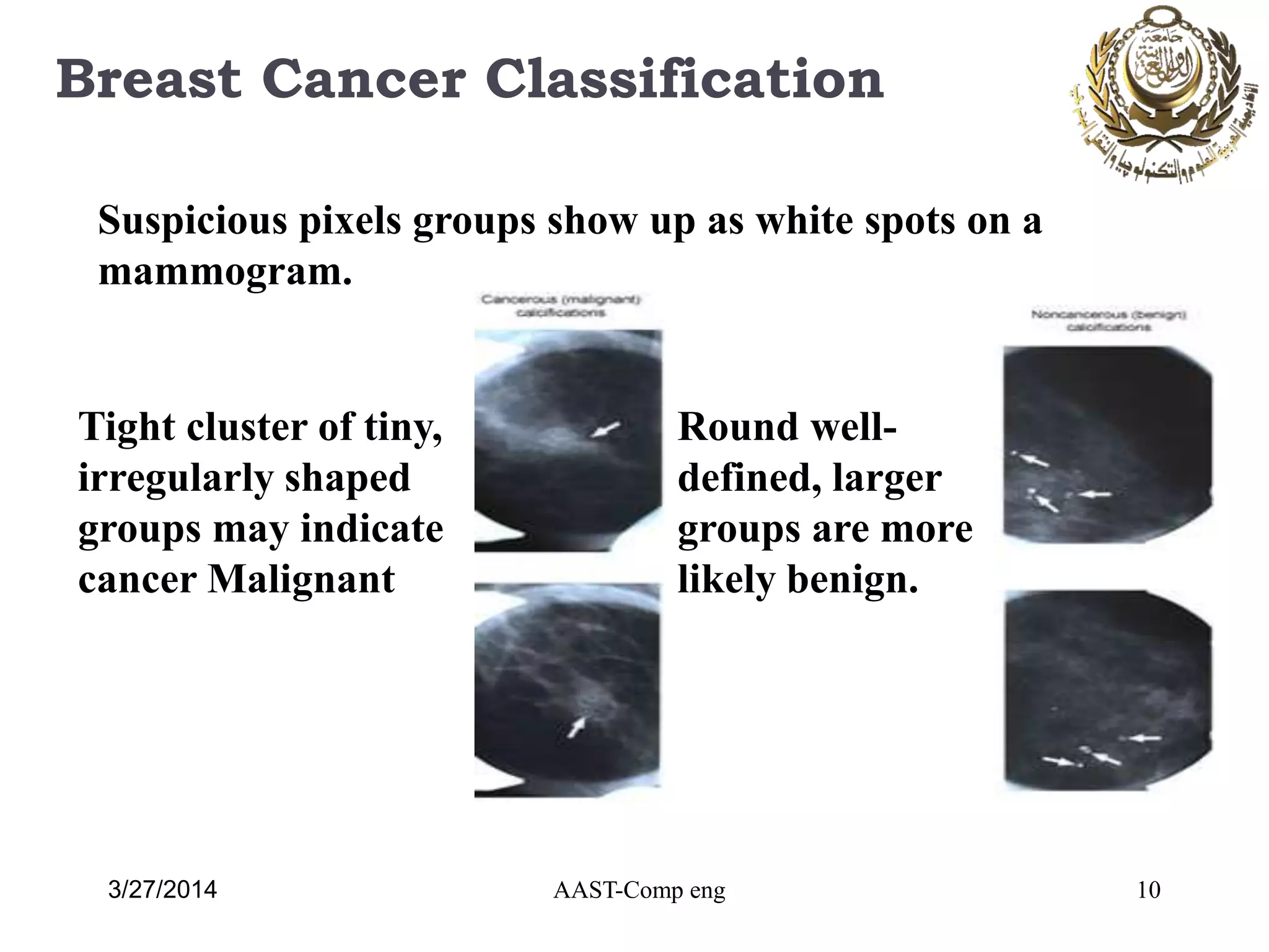 Breast Cancer Classification
10AAST-Comp eng
Round well-
defined, larger
groups are more
likely benign.
Tight cluster of tiny,
irregularly shaped
groups may indicate
cancer Malignant
Suspicious pixels groups show up as white spots on a
mammogram.
3/27/2014
 