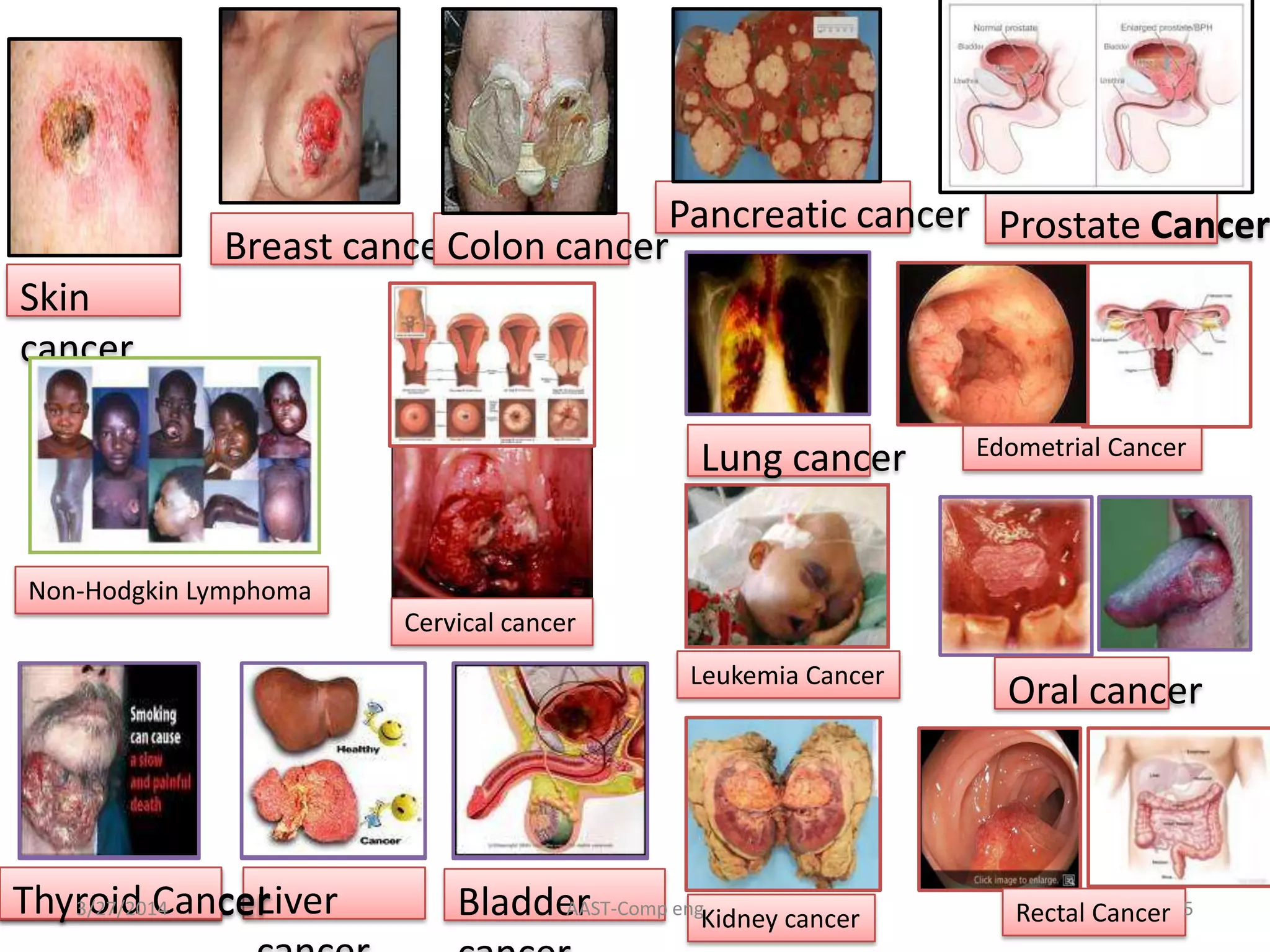 Skin
cancer
Breast cancerColon cancer
Lung cancer
Pancreatic cancer
Liver Bladder
Prostate Cancer
Kidney cancerThyroid Cancer
Leukemia Cancer
Edometrial Cancer
Rectal Cancer
Non-Hodgkin Lymphoma
Cervical cancer
Thyroid Cancer
Oral cancer
AAST-Comp eng 53/27/2014
 