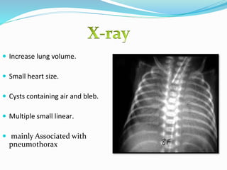Small Bleb Air Leak Syndrome | PPTX