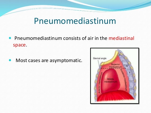 Air Leak Syndrome xray tube diagram 