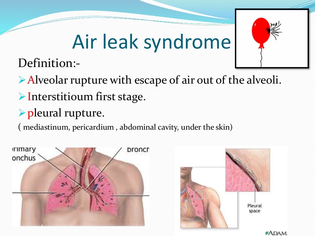 Air Leak Syndrome