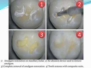 1) Amalgam restoration on maxillary molar. 2) Air abrasion device used to remove
amalgam.
3) Complete removal of amalgam restoration 4) Tooth restores with composite resin.
 