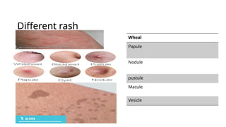 Comprehensive Overview of Airborne and Exanthematous Fevers: Symptoms ...