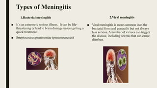 Types of Meningitis
■ It’s an extremely serious illness. It can be life-
threatening or lead to brain damage unless getting a
quick treatment.
■ Streptococcus pneumoniae (pneumococcus)
1.Bacterial meningitis 2.Viral meningitis
■ Viral meningitis is more common than the
bacterial form and generally but not always
less serious. A number of viruses can trigger
the disease, including several that can cause
diarrhea.
 