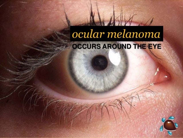 Ocular Melanoma Tanning Beds Ocular Melanoma Tanning Beds