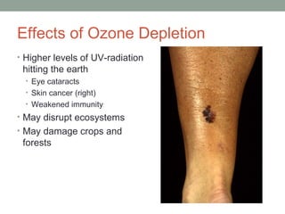 Effects of Ozone Depletion
• Higher levels of UV-radiation
hitting the earth
• Eye cataracts
• Skin cancer (right)
• Weakened immunity
• May disrupt ecosystems
• May damage crops and
forests
 