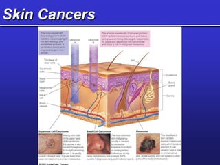 Skin Cancers
 