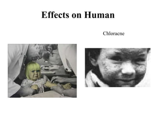 Effects on Human
Chloracne
 