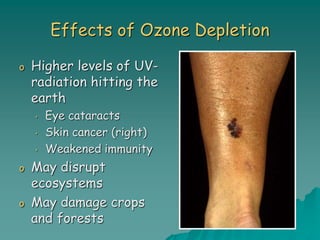 Effects of Ozone Depletion
o Higher levels of UV-
radiation hitting the
earth
• Eye cataracts
• Skin cancer (right)
• Weakened immunity
o May disrupt
ecosystems
o May damage crops
and forests
 